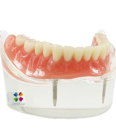 iDENTical Mandibular Overdenture Model with 2 Implants M6002