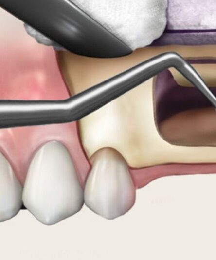 sinus-lift-kit-2