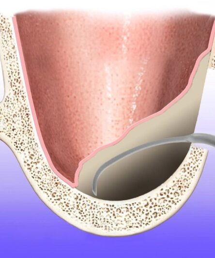 sinus-lift-kit-2