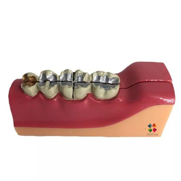 iDENTical Third molar Impaction Teeth Model M4009