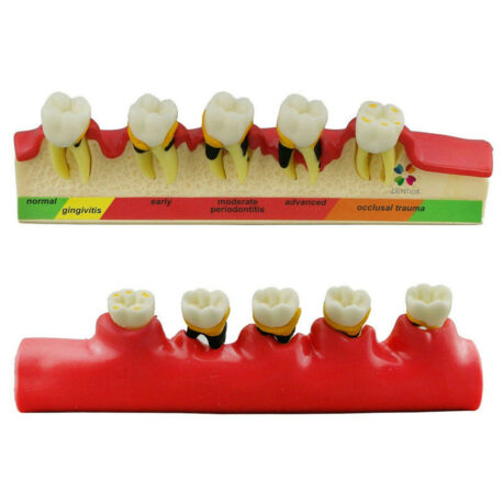 iDENTical Dental Model - Stages of Periodontitis M4010