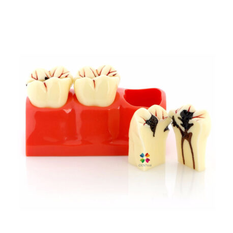 iDENTical Caries Development Tooth Model M4020