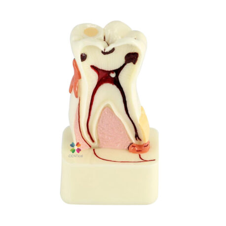 iDENTical Dental Model for 4X Pathologies of Tooth M4015