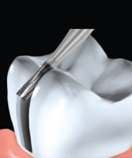 beast-carbide-crown-_-metal-cutting-bur-3