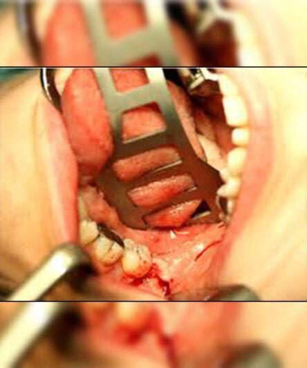 retractor-3