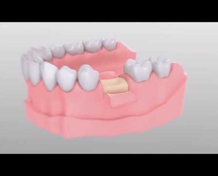implantmed_product_1