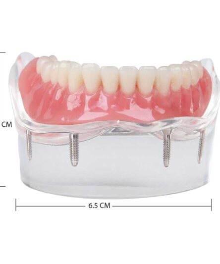 new-dental-tooths-model-overdenture-inferior-with-4-_57