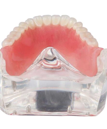 new-dental-tooths-model-overdenture-inferior-with-4-_57