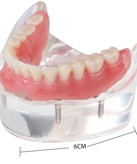 new-dental-tooths-model-overdenture-inferior-with-4-_57