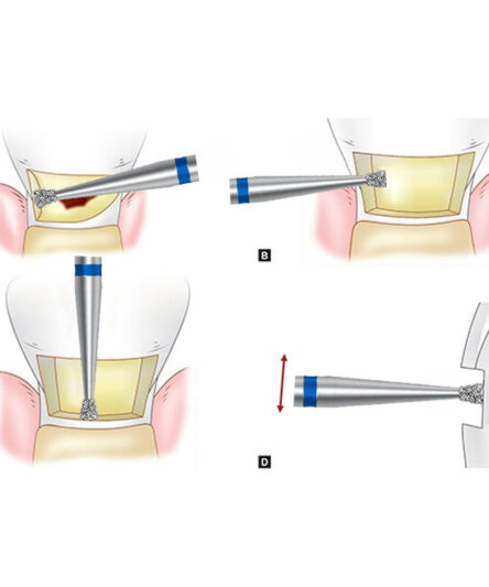 inverted-cone-bur-3