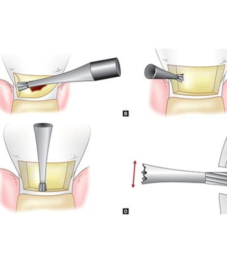 inverted_cone_4_1