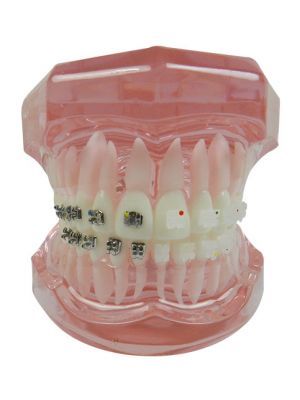 iDENTical Half Metal and Half Ceramic Brackets Orthodontics Model M3003 Red