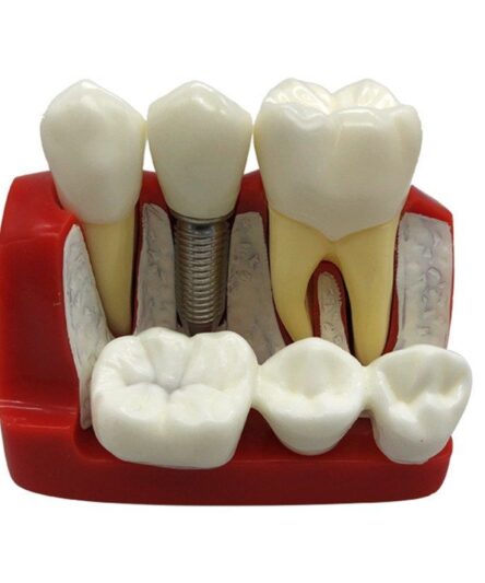 iDENTical Implant Analysis Model M2017