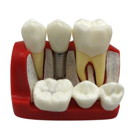 iDENTical Implant Analysis Model M2017