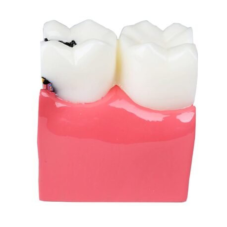 iDENTical Caries V/S Healthy Teeth Model M4021