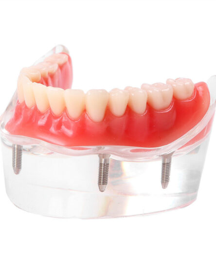 new-dental-tooths-model-overdenture-inferior-with-4-_57