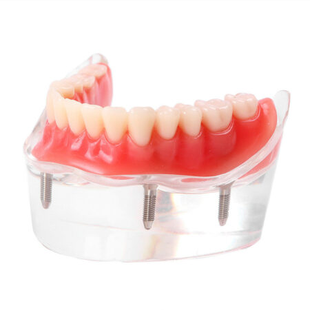 iDENTical Mandibular Overdenture Model with 4 Implants M6003