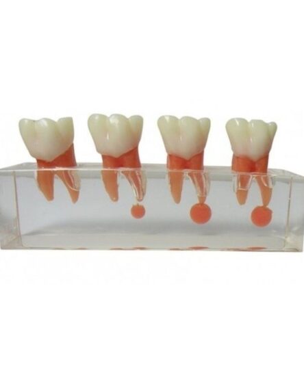 iDENTical Study Model Root Canal Treatment M 4018