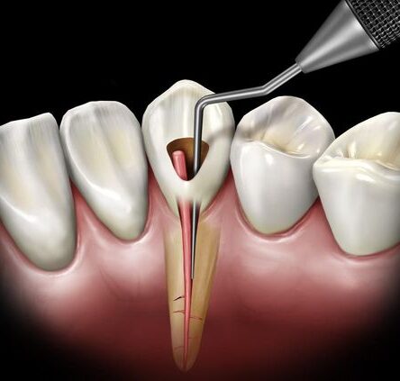 root-canal-spreaders