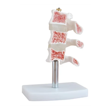 Divine Medicare - Cutaway Osteoporosis Anatomical Model