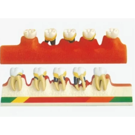 Periodontal Disease Model By Divine Medicare