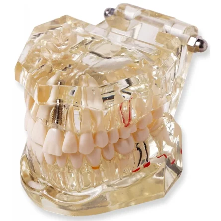 Dental Model With Pathologies To Demonstrate Dental Implants