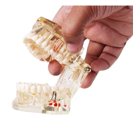 Dental Model With Pathologies To Demonstrate Dental Implants