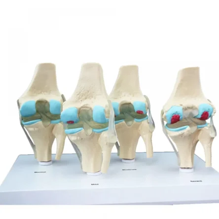 Divine Medicare – Knee 4 Stage Arthritis Model
