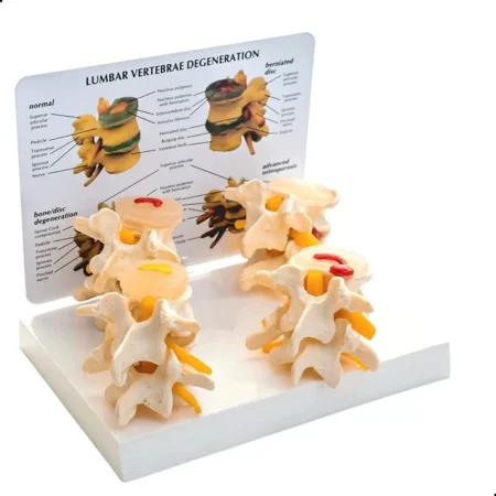 Divine Medicare - Lumbar Vertebrae 4-Stage Degenration Model