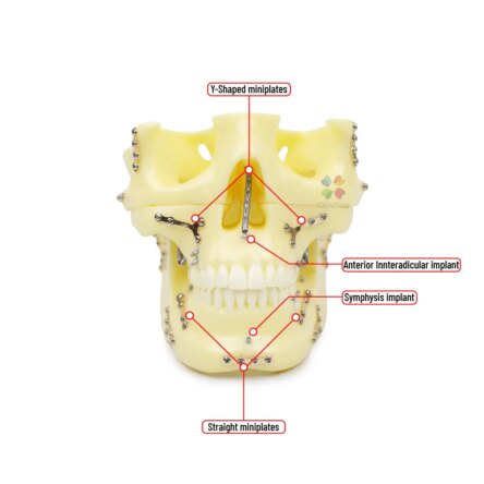 iDENTical Skull Education Model With Fracture And Restoration (M5004)