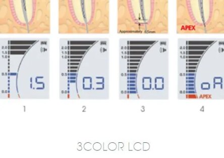 Nsk Ipex II Apex Locator Complete Set