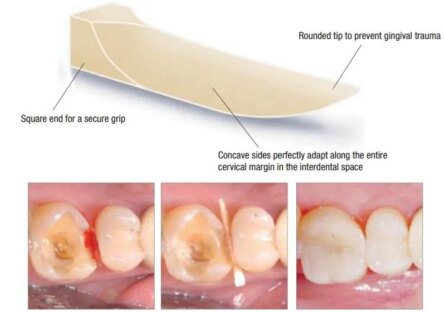 ET Dental Wooden Wedges Kit