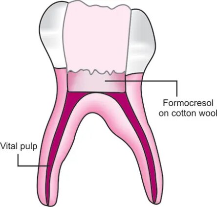 DentGist Buckley’s Formocresol