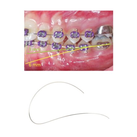 U Ortho Niti reverse curve arch wire-Ovoid Lower 0.014 Pk of 2