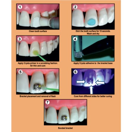 Prevest Denpro Fusion Crysta Orthodontic Adhesive Kit (10024)