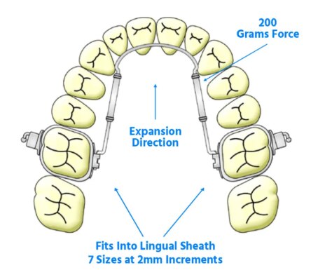 Ortho Organizers Transforce Sagittal Appliance – 40mm