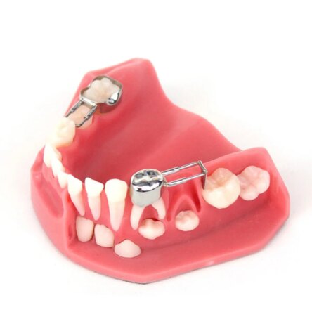 Kids-e-Dental Space Maintainer Band – 42